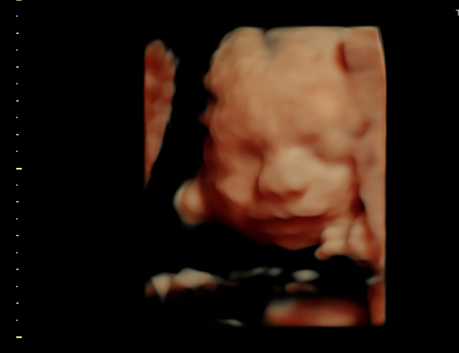 3D ultrasound image at 25 weeks